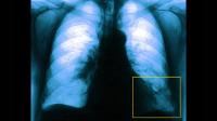 embolia polmone