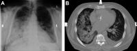 radiografie edema polmonare