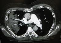 polmonite radiografia
